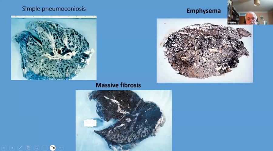 Embedded thumbnail for SOM Basics in OH webinar series -1 respiratory issues in OH (pneumoconiosis and silicosis)
